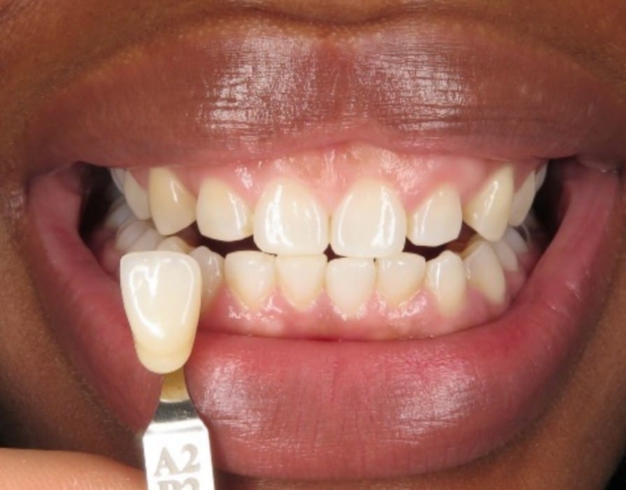 cs-teeth-result1