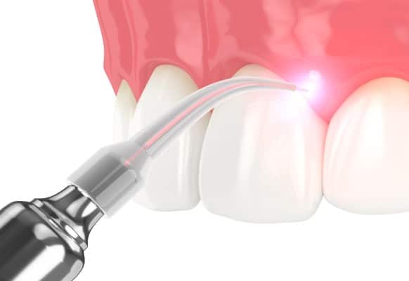 _Uses of Laser Dentistry_