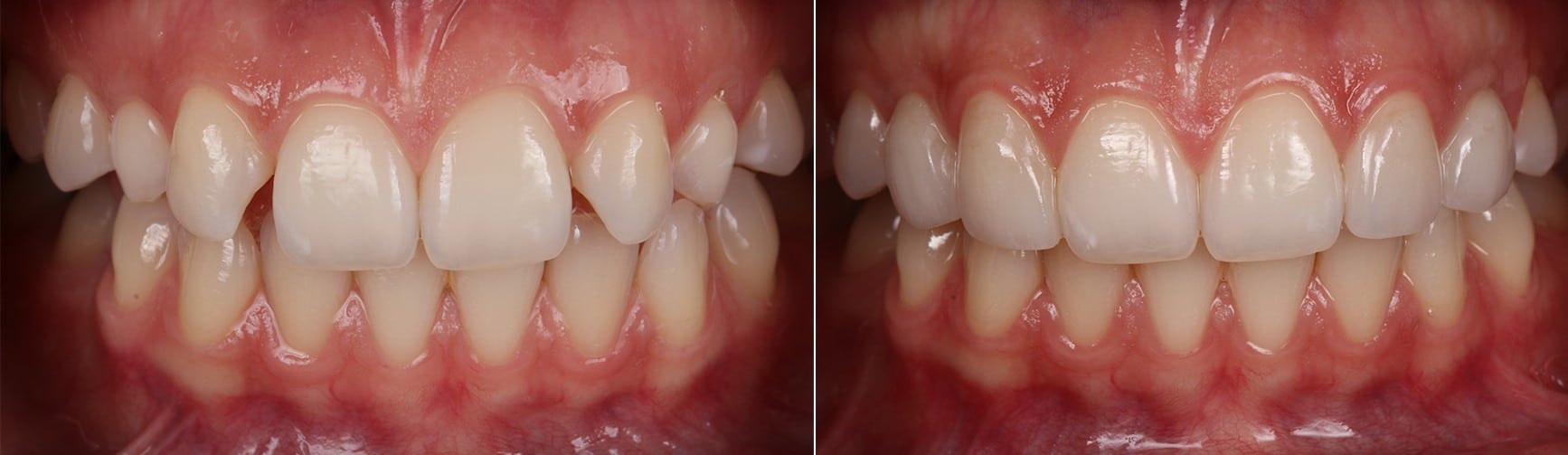 Implant and Crowns Case